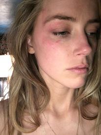 Amber Heard Accuses Johnny Depp of Domestic Violence with Graphic Photo of Bruise_ 'This Was Not an Isolated Event,' Says Source_ Mov_0001.jpg